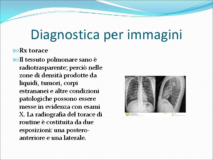 Diagnostica per immagini Rx torace Il tessuto polmonare sano è radiotrasparente; perciò nelle zone
