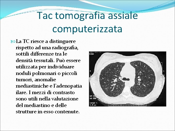 Tac tomografia assiale computerizzata La TC riesce a distinguere rispetto ad una radiografia, sottili