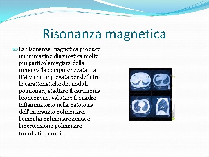 Risonanza magnetica La risonanza magnetica produce un immagine diagnostica molto più particolareggiata della tomografia