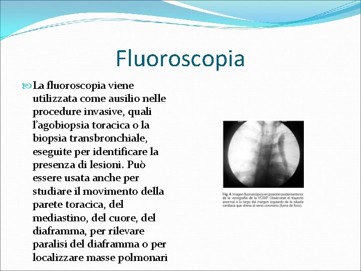 Fluoroscopia La fluoroscopia viene utilizzata come ausilio nelle procedure invasive, quali l’agobiopsia toracica o