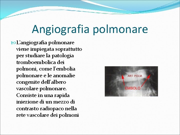 Angiografia polmonare L’angiografia polmonare viene impiegata soprattutto per studiare la patologia tromboembolica dei polmoni,