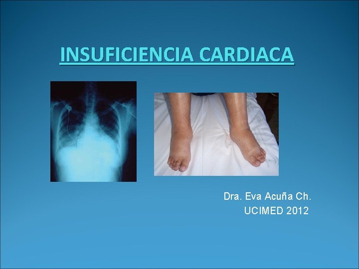 INSUFICIENCIA CARDIACA Dra. Eva Acuña Ch. UCIMED 2012 
