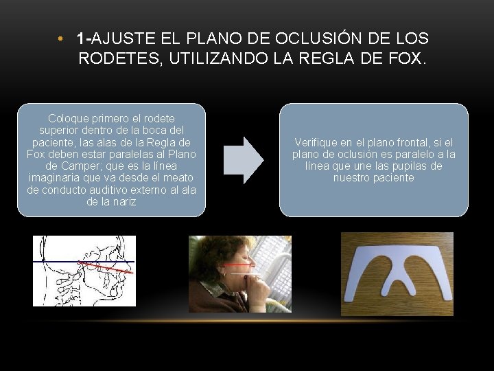 • 1 -AJUSTE EL PLANO DE OCLUSIÓN DE LOS RODETES, UTILIZANDO LA REGLA • 1 -AJUSTE EL PLANO DE OCLUSIÓN DE LOS RODETES, UTILIZANDO LA REGLA