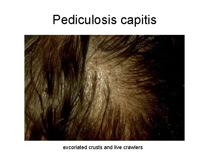 Pediculosis capitis excoriated crusts and live crawlers 
