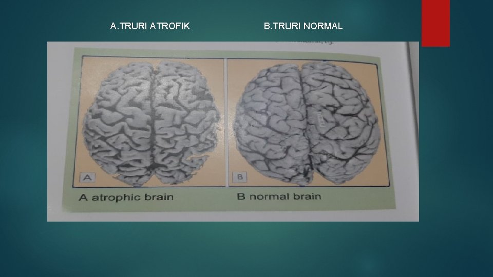 A. TRURI ATROFIK B. TRURI NORMAL 