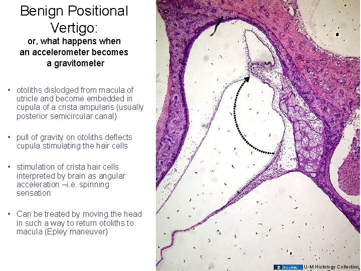 Benign Positional Vertigo: or, what happens when an accelerometer becomes a gravitometer • otoliths