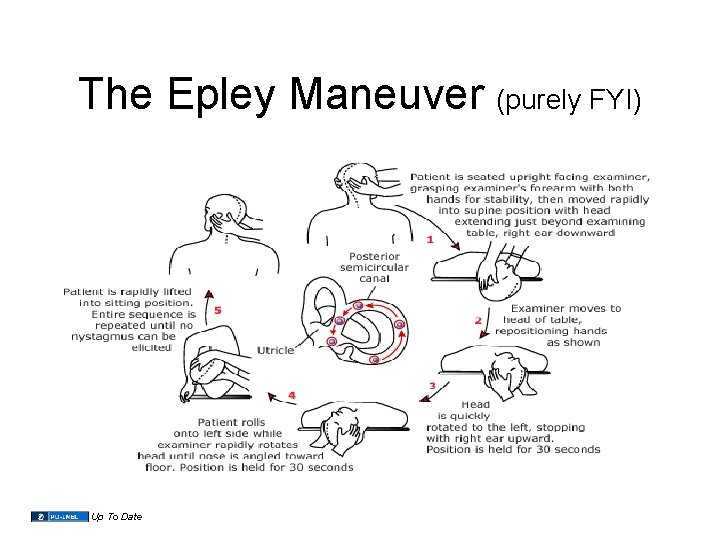 The Epley Maneuver (purely FYI) Up To Date 