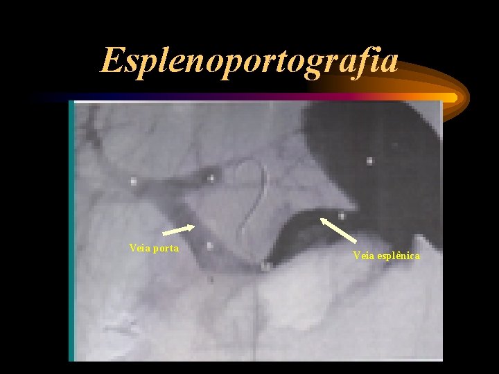 Esplenoportografia Veia porta Veia esplênica 