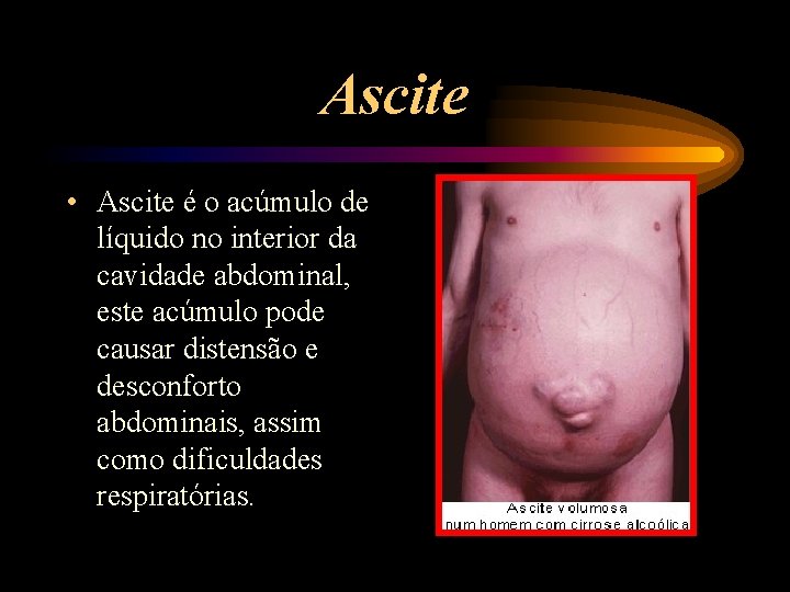 Ascite • Ascite é o acúmulo de líquido no interior da cavidade abdominal, este