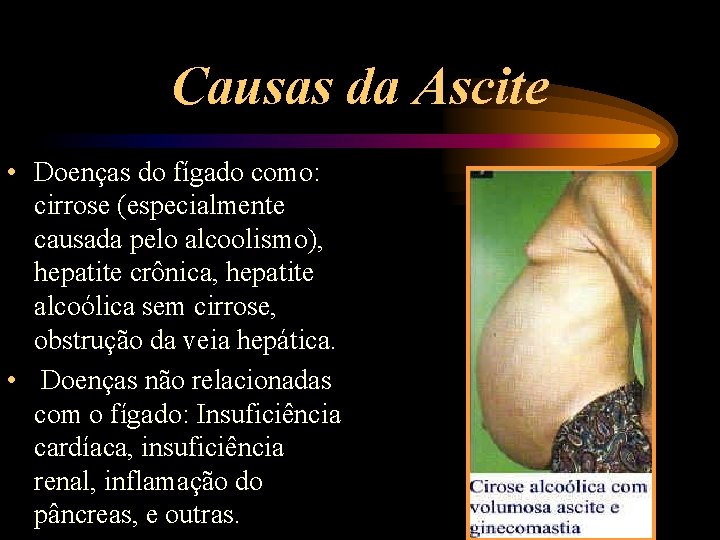Causas da Ascite • Doenças do fígado como: cirrose (especialmente causada pelo alcoolismo), hepatite