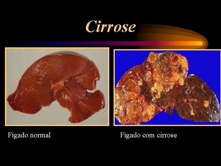 Cirrose Fígado normal Fígado com cirrose 