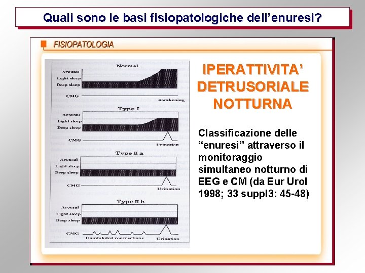 Quali sono le basi fisiopatologiche dell’enuresi? IPERATTIVITA’ DETRUSORIALE NOTTURNA Classificazione delle “enuresi” attraverso il