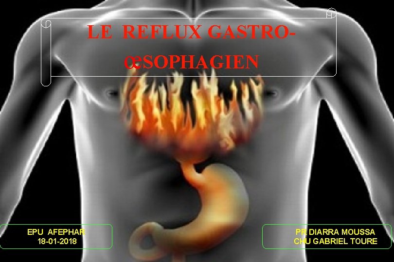 LE REFLUX GASTRO- œSOPHAGIEN EPU AFEPHAR 18 -01 -2018 PR DIARRA MOUSSA CHU GABRIEL