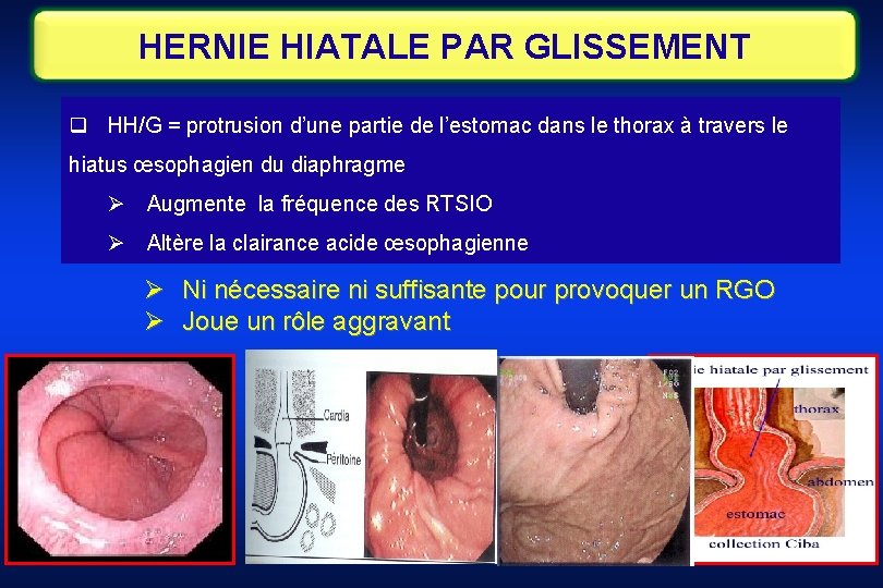 HERNIE HIATALE PAR GLISSEMENT q HH/G = protrusion d’une partie de l’estomac dans le