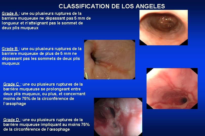 CLASSIFICATION DE LOS ANGELES Grade A : une ou plusieurs ruptures de la barrière