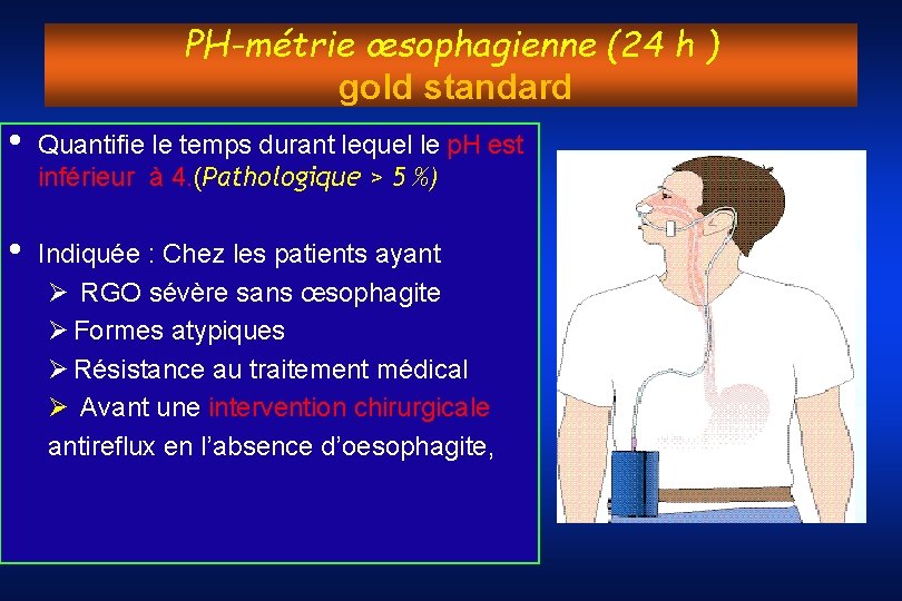 PH-métrie œsophagienne (24 h ) gold standard • Quantifie le temps durant lequel le