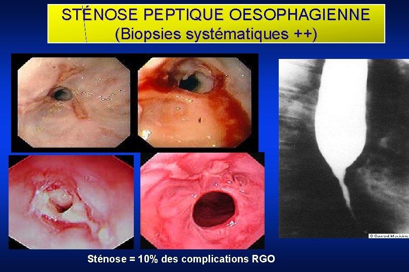 STÉNOSE PEPTIQUE OESOPHAGIENNE (Biopsies systématiques ++) Sténose = 10% des complications RGO 