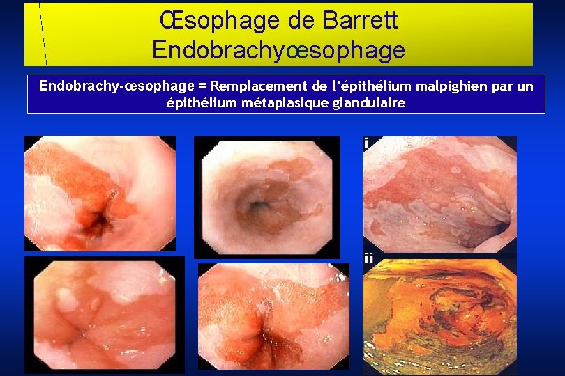 Œsophage de Barrett Endobrachyœsophage Endobrachy-œsophage = Remplacement de l’épithélium malpighien par un épithélium métaplasique