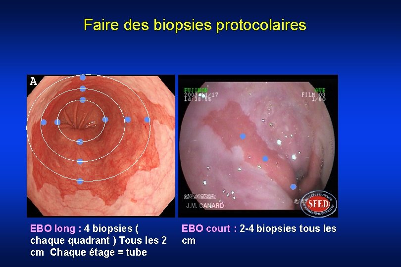 Faire des biopsies protocolaires EBO long : 4 biopsies ( chaque quadrant ) Tous