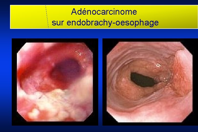 Adénocarcinome sur endobrachy-oesophage 