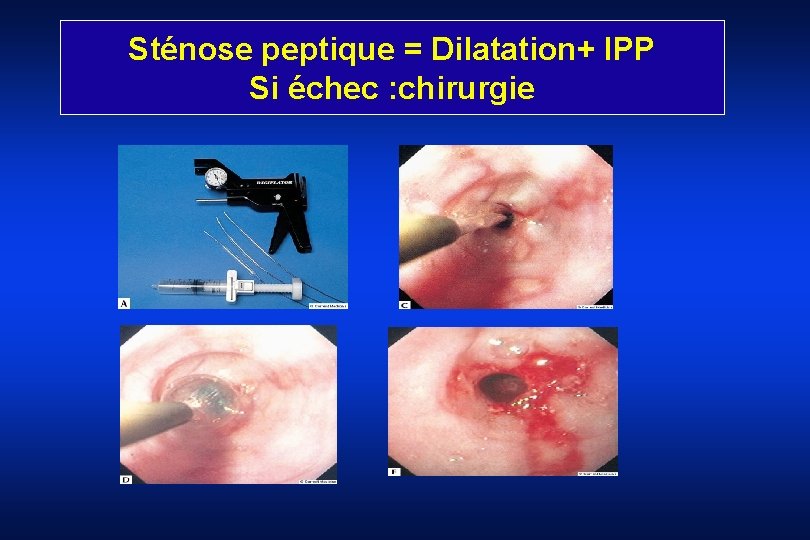 Sténose peptique = Dilatation+ IPP Si échec : chirurgie 