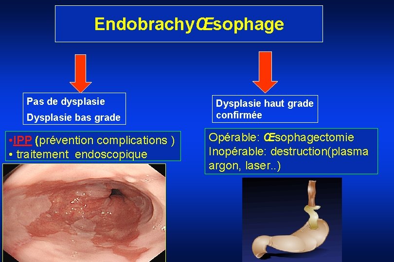 EndobrachyŒsophage Pas de dysplasie Dysplasie bas grade • IPP (prévention complications ) • traitement