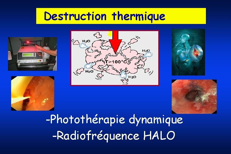 Destruction thermique -Photothérapie dynamique -Radiofréquence HALO 