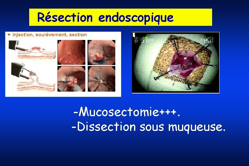 Résection endoscopique -Mucosectomie+++. -Dissection sous muqueuse. 