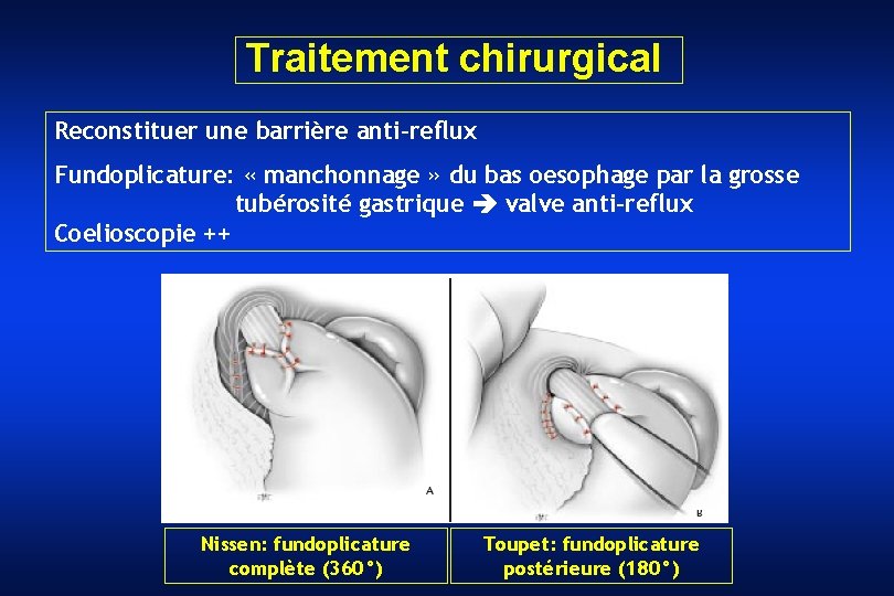 Traitement chirurgical Reconstituer une barrière anti-reflux Fundoplicature: « manchonnage » du bas oesophage par