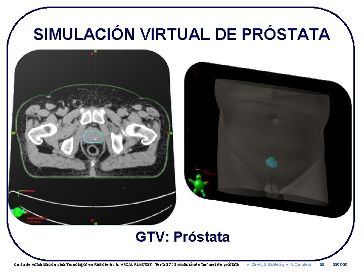 SIMULACIÓN VIRTUAL DE PRÓSTATA GTV: Próstata Curso de Actualización para Tecnólogos en Radioterapia. ARCAL