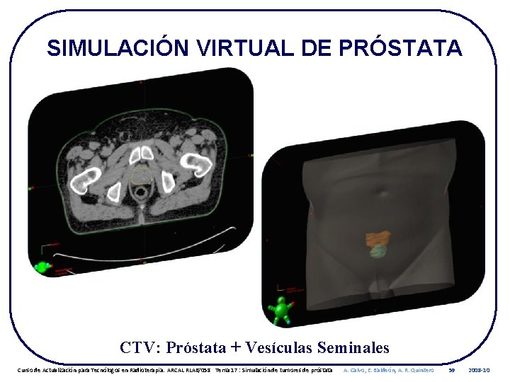 SIMULACIÓN VIRTUAL DE PRÓSTATA CTV: Próstata + Vesículas Seminales Curso de Actualización para Tecnólogos
