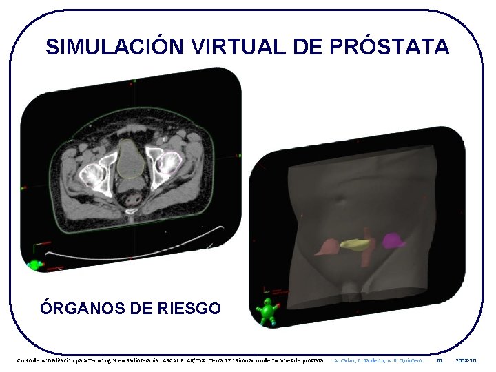 SIMULACIÓN VIRTUAL DE PRÓSTATA ÓRGANOS DE RIESGO Curso de Actualización para Tecnólogos en Radioterapia.