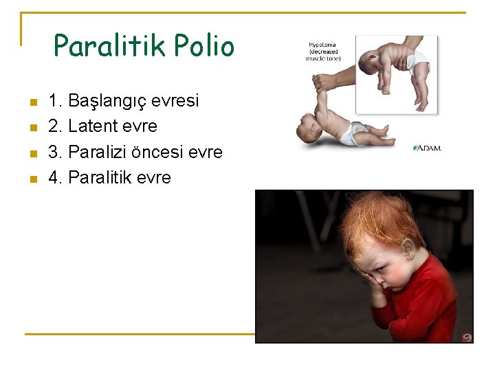  Paralitik Polio n n 1. Başlangıç evresi 2. Latent evre 3. Paralizi öncesi