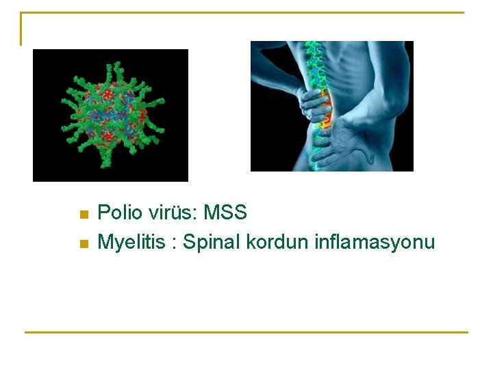 n n Polio virüs: MSS Myelitis : Spinal kordun inflamasyonu 
