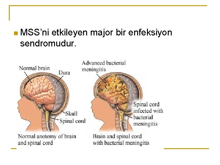 n MSS’ni etkileyen major bir enfeksiyon sendromudur. 