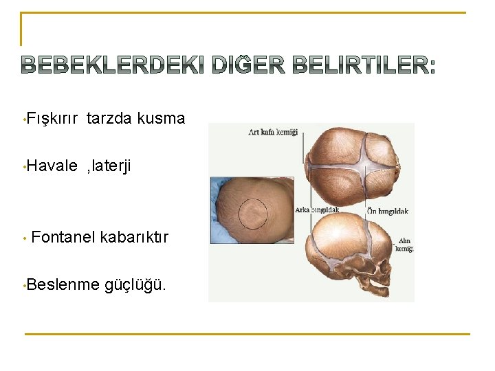  • Fışkırır tarzda kusma • Havale , laterji • Fontanel kabarıktır • Beslenme