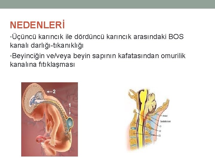 NEDENLERİ • Üçüncü karıncık ile dördüncü karıncık arasındaki BOS kanalı darlığı-tıkanıklığı • Beyinciğin ve/veya