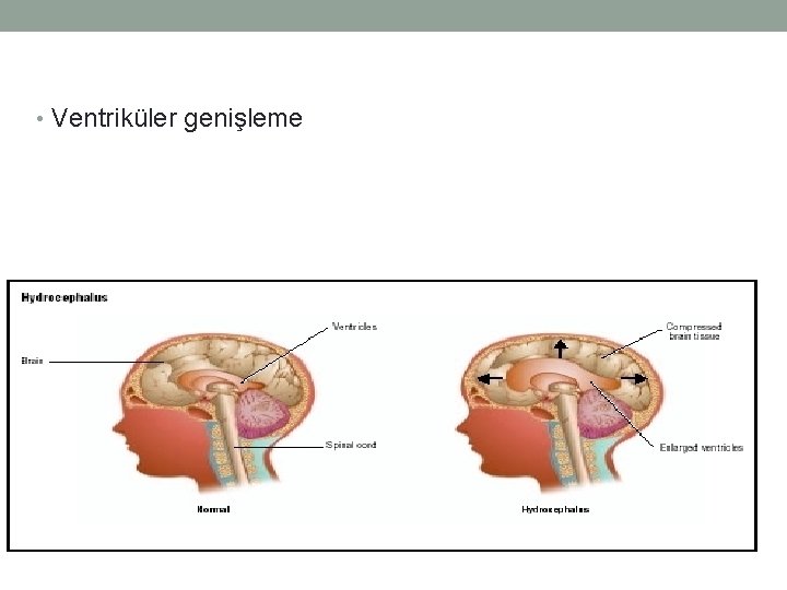  • Ventriküler genişleme 