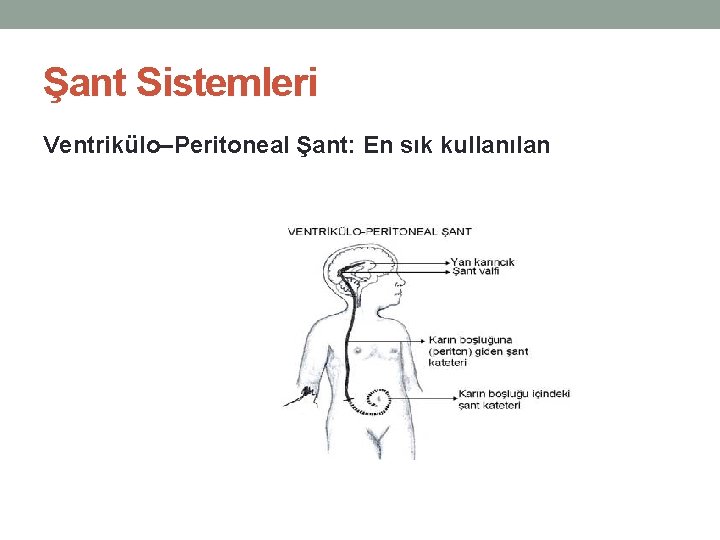 Şant Sistemleri Ventrikülo–Peritoneal Şant: En sık kullanılan 