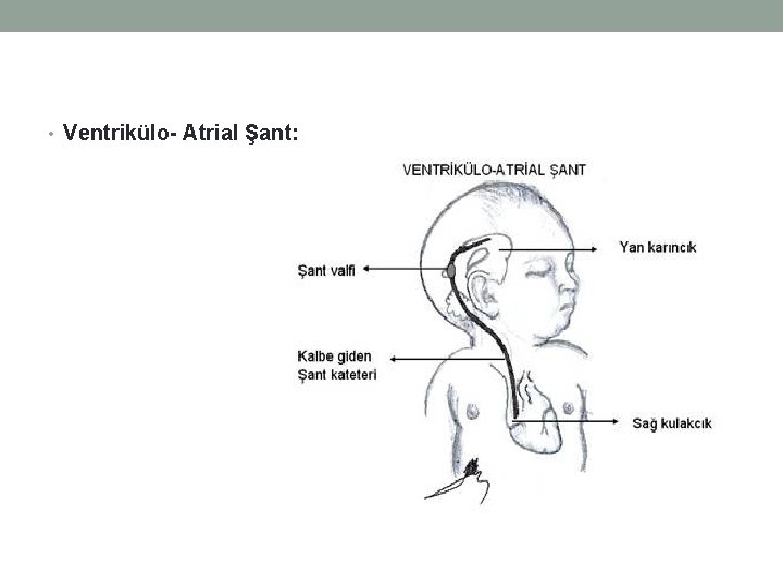  • Ventrikülo- Atrial Şant: 