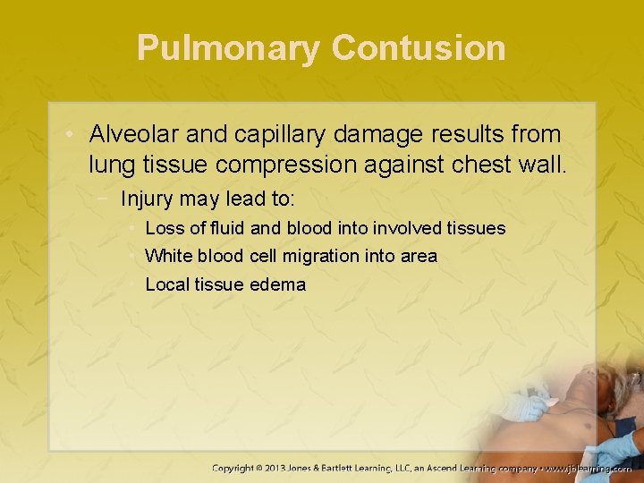 Pulmonary Contusion • Alveolar and capillary damage results from lung tissue compression against chest