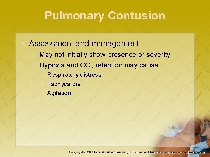 Pulmonary Contusion • Assessment and management − May not initially show presence or severity