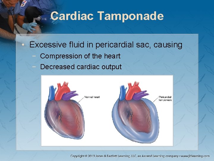 Cardiac Tamponade • Excessive fluid in pericardial sac, causing − Compression of the heart
