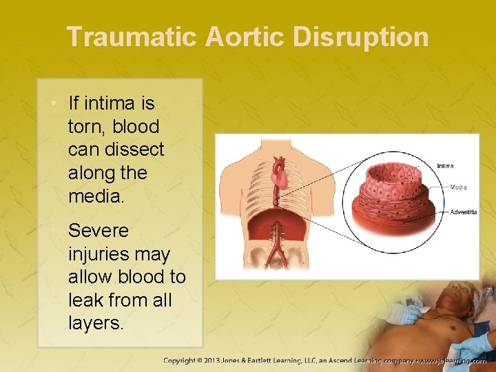 Traumatic Aortic Disruption • If intima is torn, blood can dissect along the media.