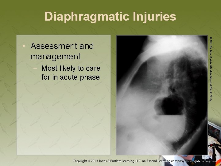 Diaphragmatic Injuries − Most likely to care for in acute phase © SIU Bio