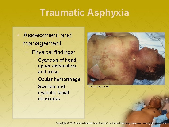 Traumatic Asphyxia • Assessment and management − Physical findings: • Cyanosis of head, upper