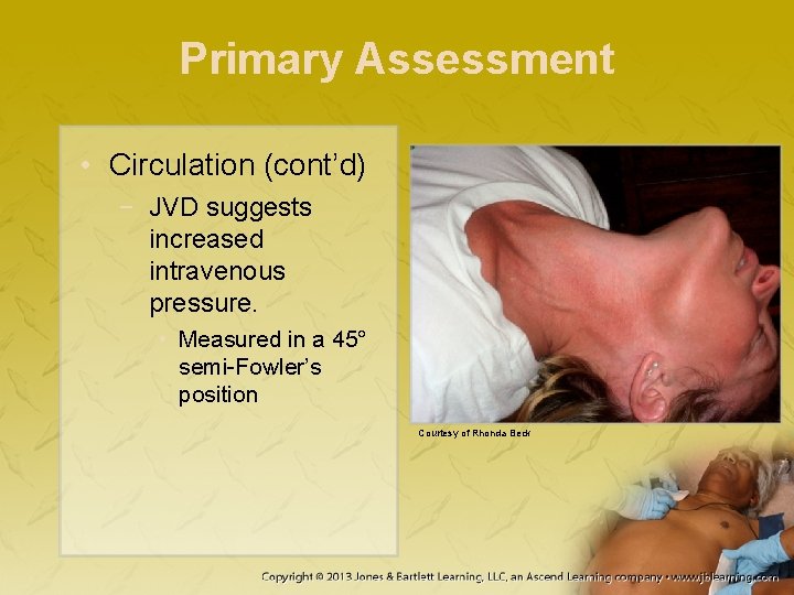 Primary Assessment • Circulation (cont’d) − JVD suggests increased intravenous pressure. • Measured in