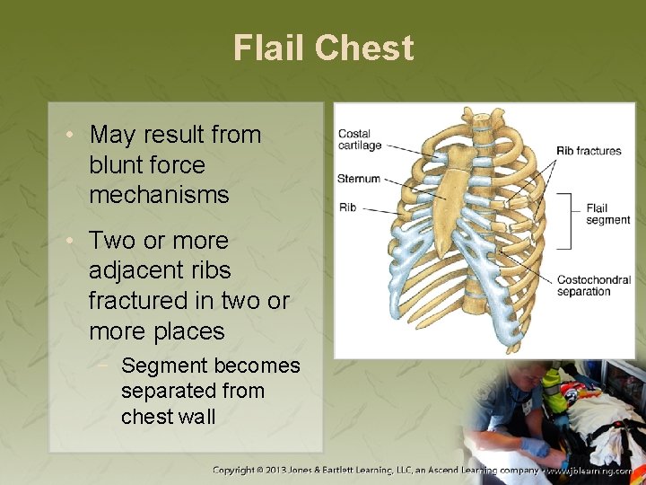 Flail Chest • May result from blunt force mechanisms • Two or more adjacent