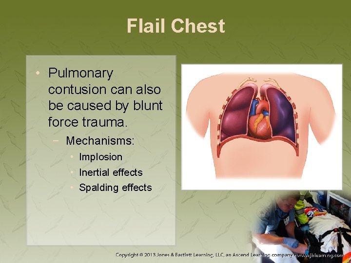Flail Chest • Pulmonary contusion can also be caused by blunt force trauma. −