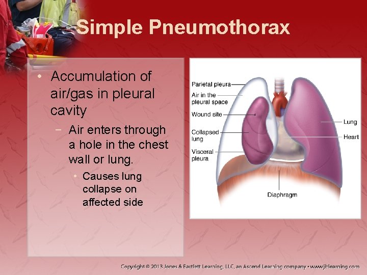 Simple Pneumothorax • Accumulation of air/gas in pleural cavity − Air enters through a